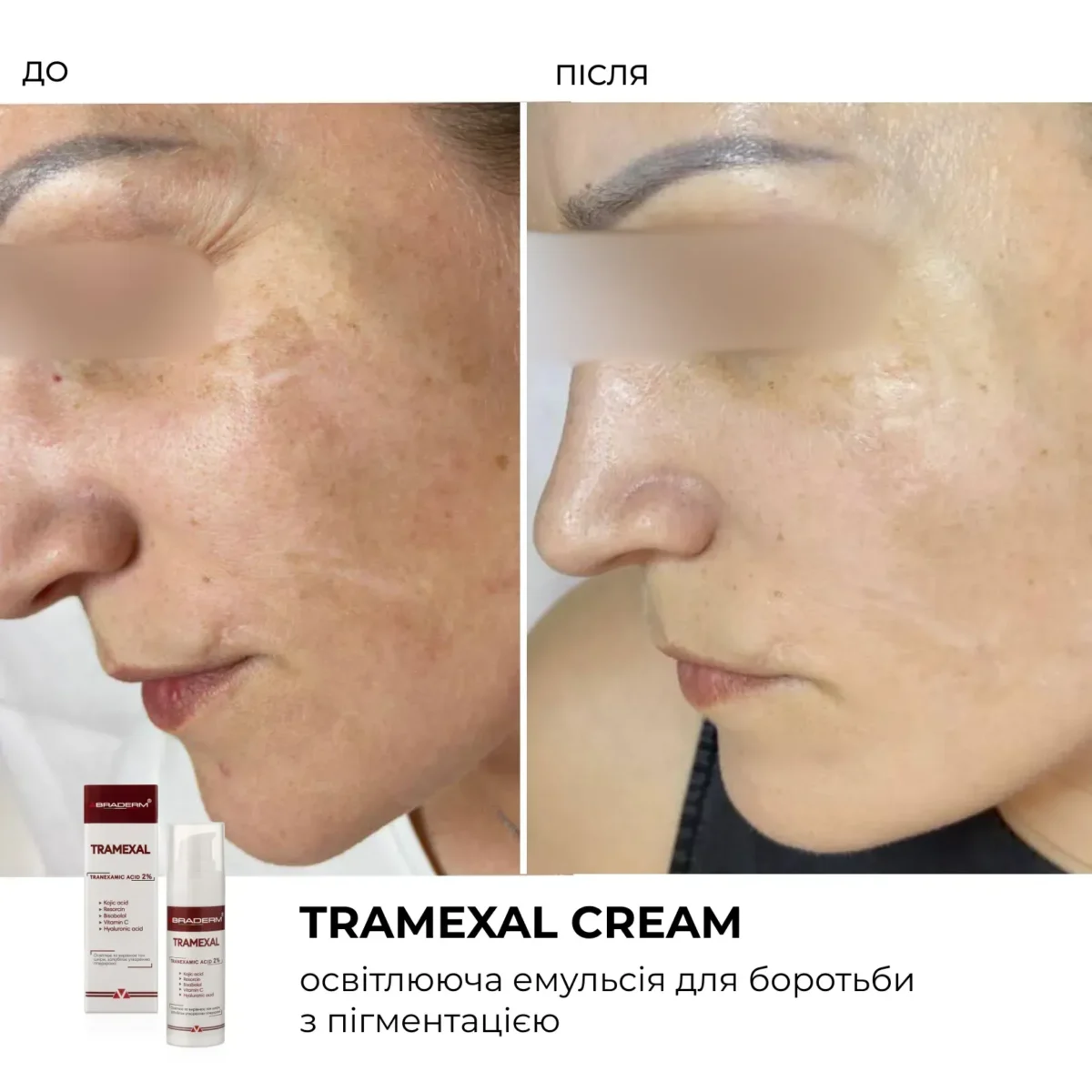 braderm-tramexal-cream-info
